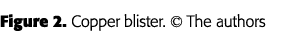 Figure 2  Copper blister    The authors