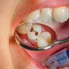 Photo of caries in human teeth.